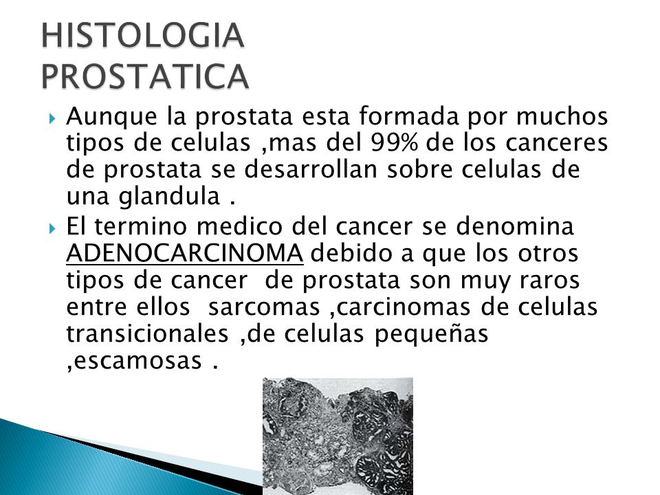 cancer de prostata histologia